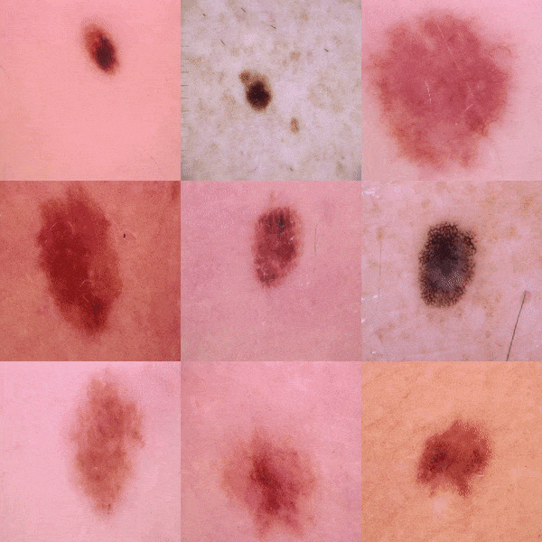 skin_cancer.png